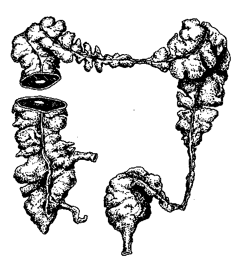  [An inflamed and constricted colon, leading to worsened constipation and increased toxicity due to lack of bowel movements (12)] 
